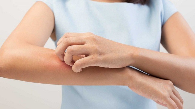 Sản phẩm đông trùng hạ thảo có thể gây dị ứng mẩn đỏ